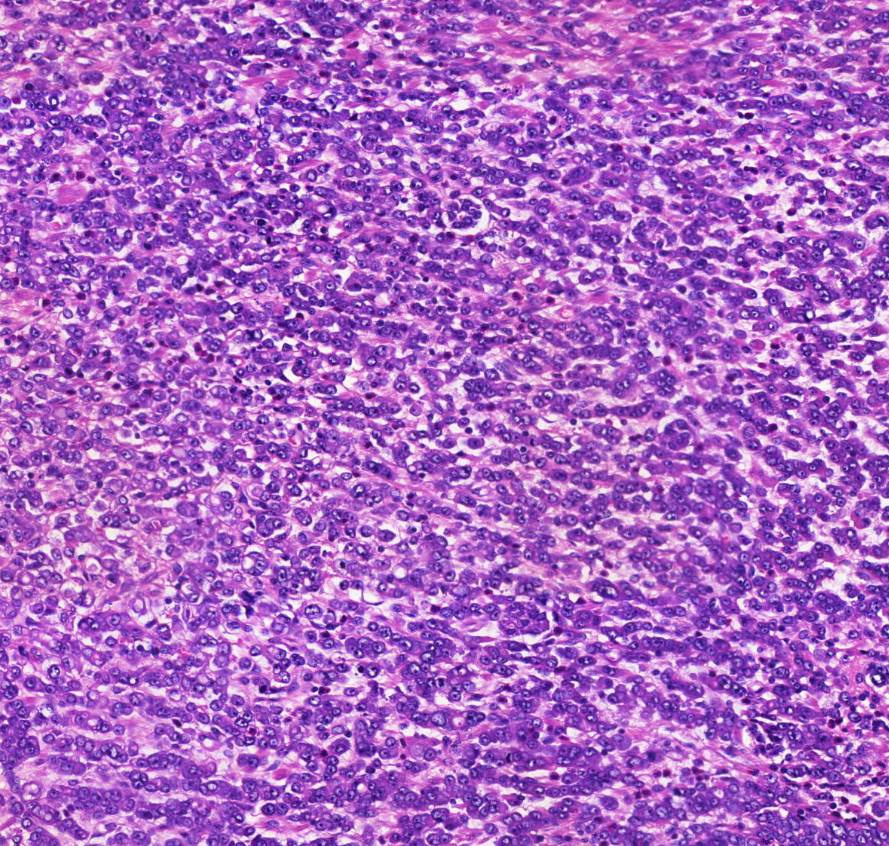 Adenocarcinoma ventriculi (diffuse type) 0