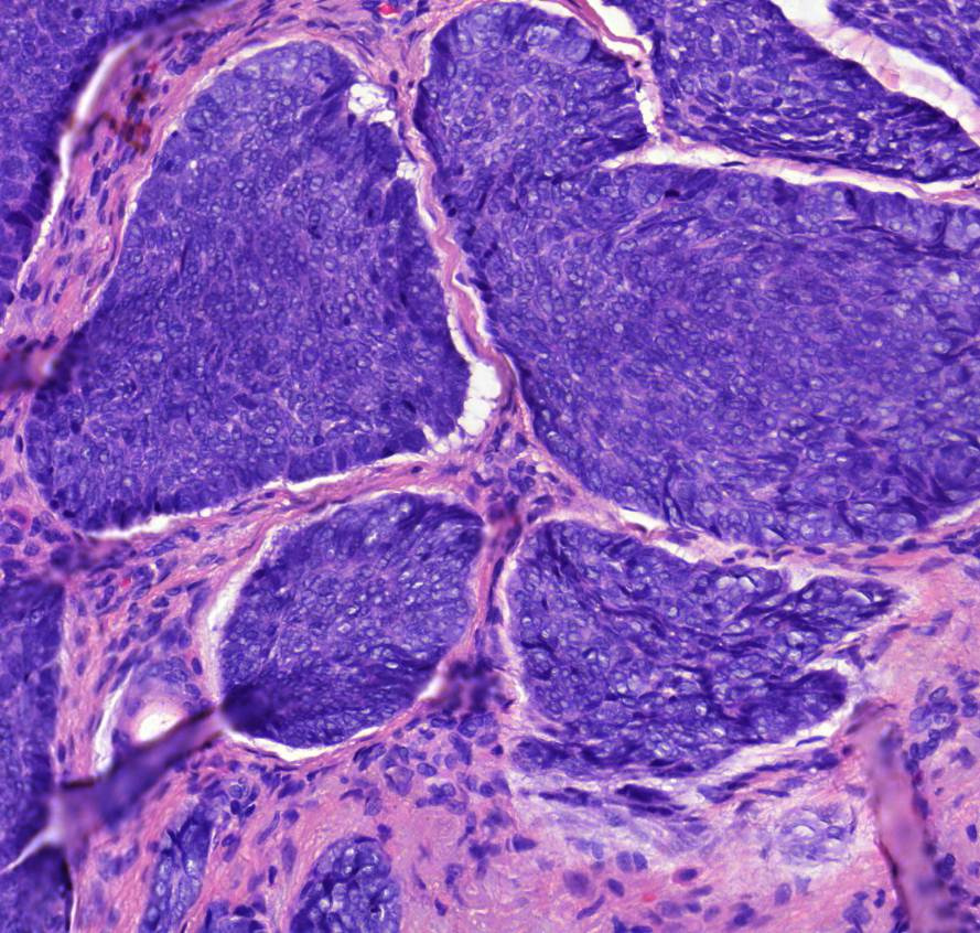 carcinoma basocellulare 1