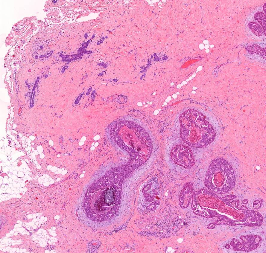 microcalcificatio carcinoma ductale in situ mammae norm jobbra, 