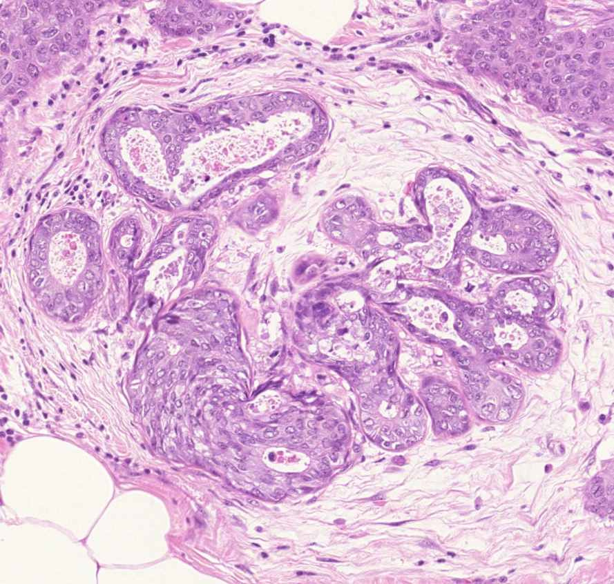 carcinoma ductale invasivum mammae in situ