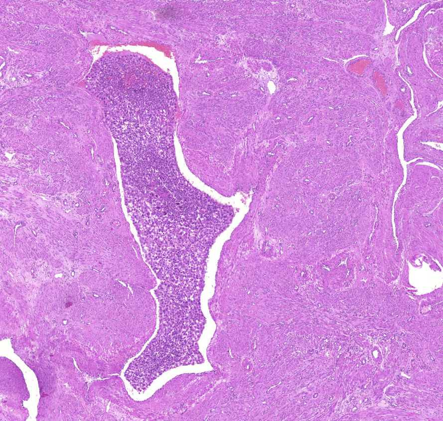 chorionepithelioma nagy ér