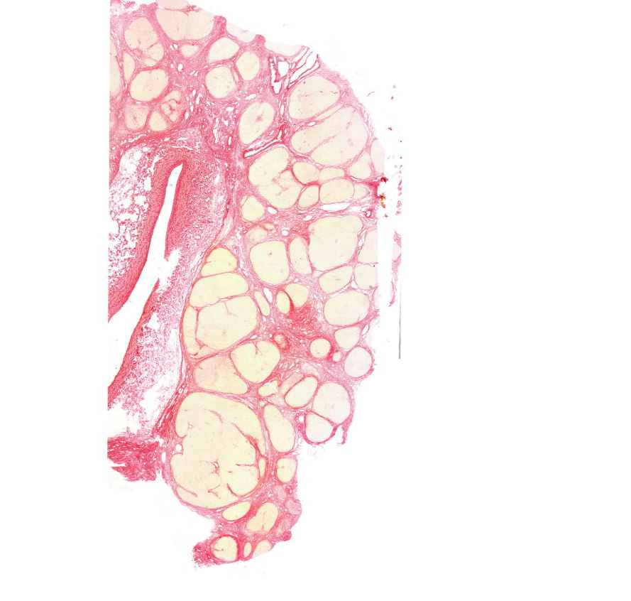 cirrhosis hepatis (picro)