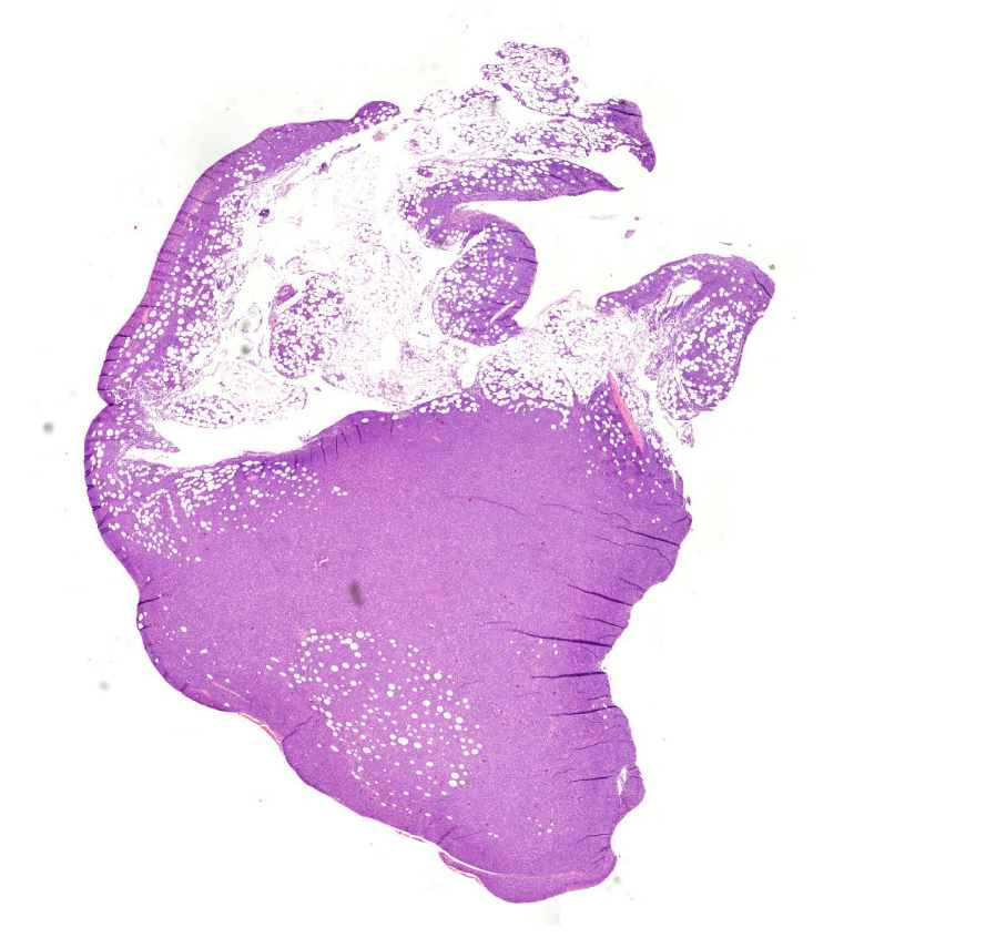 diffúz nagy B-sejtes lymphoma (HE)