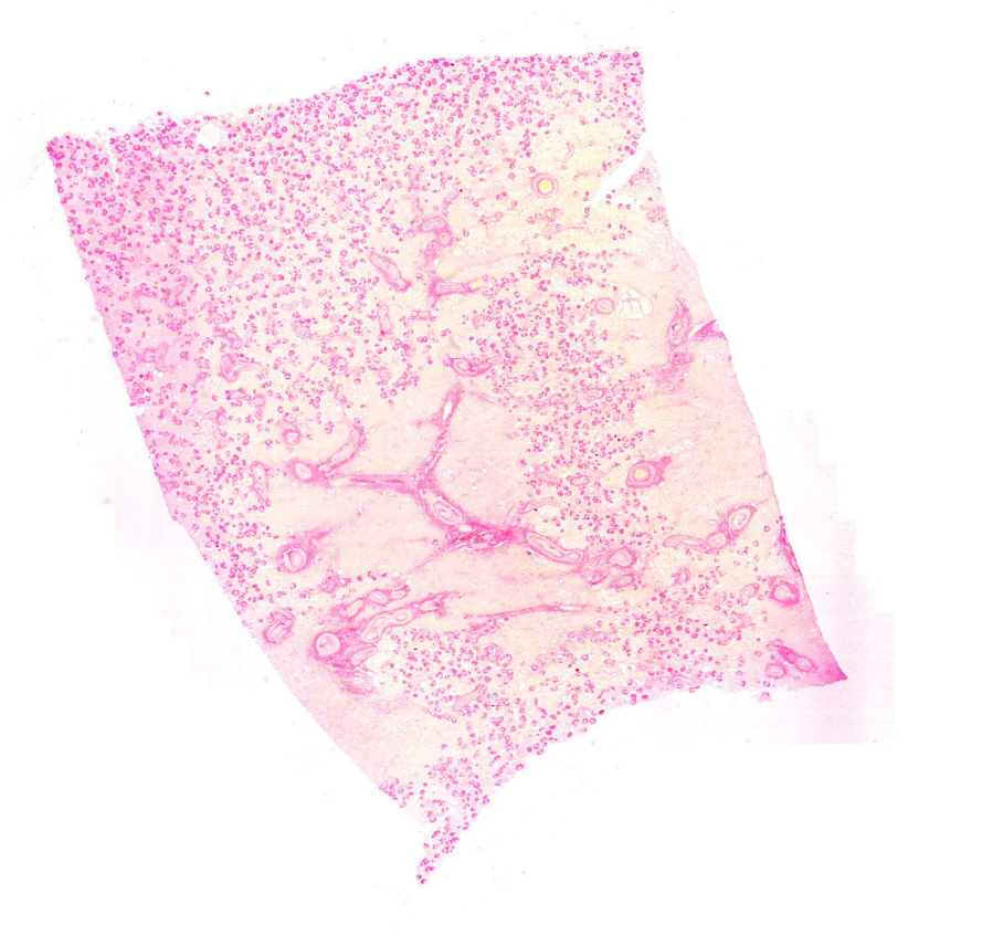 end-stage-kidney (picro)