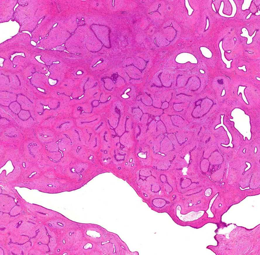 fibroadenoma mirigyek