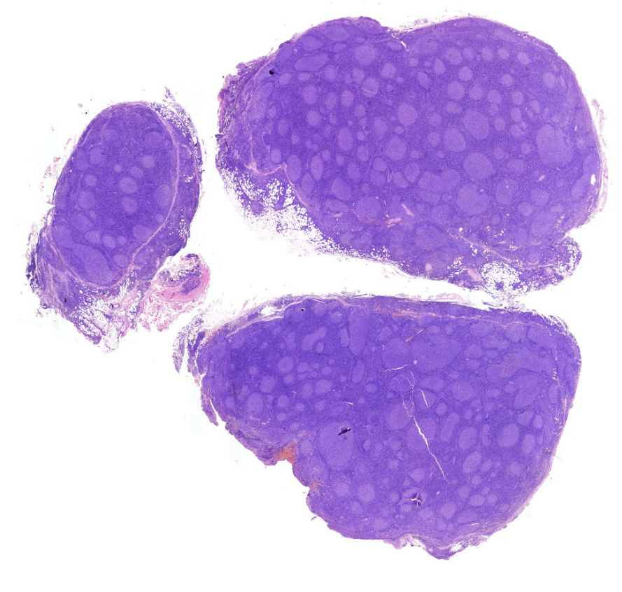 follicularis lymphoma (HE)