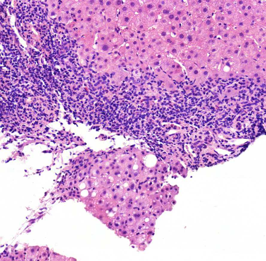 hepatitis chronica elmosódott határ