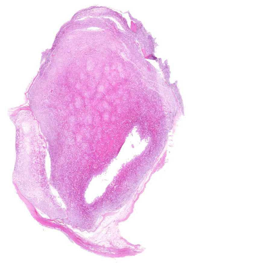 liposarcoma