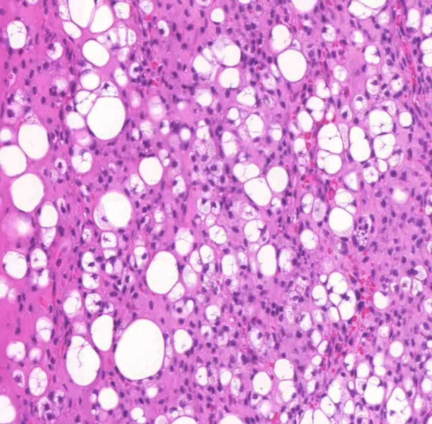 liposarcoma-lipoblastok