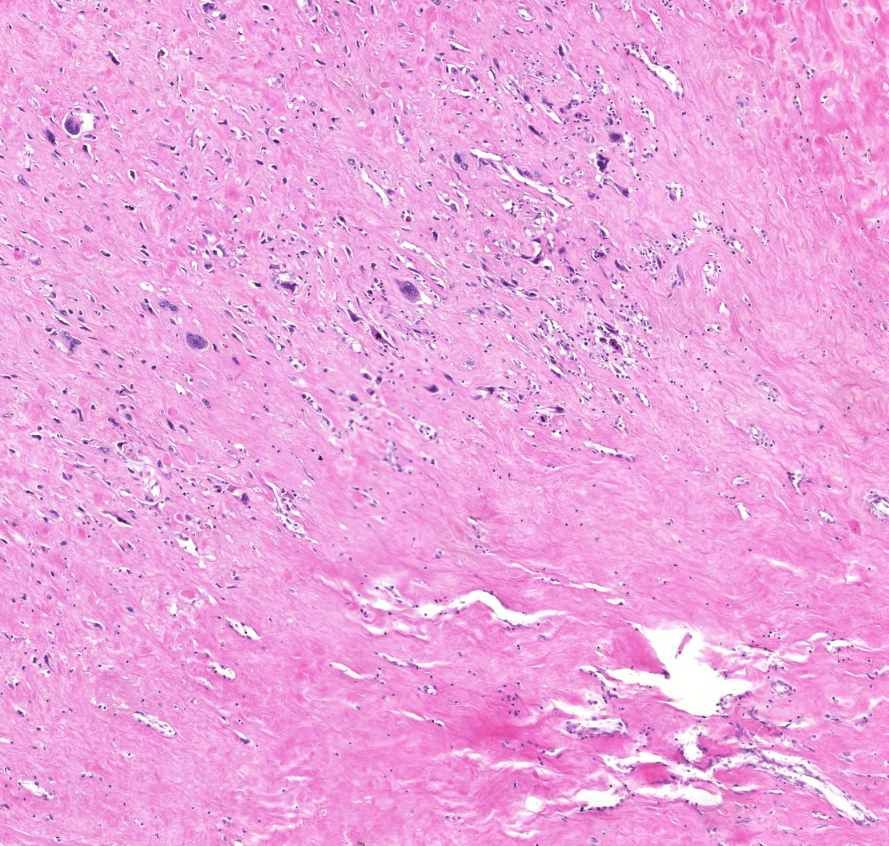 osteosarcoma0