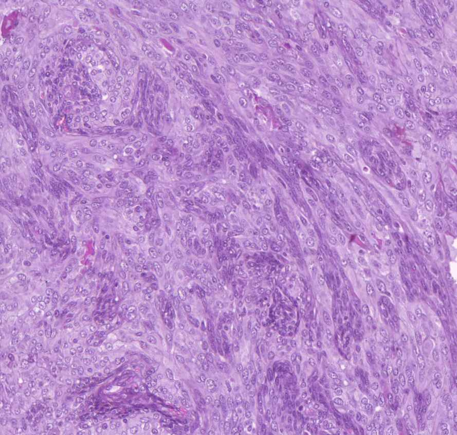 synovialis-sarcoma0