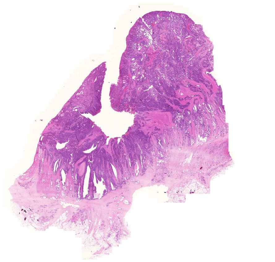 adenocarcinoma coli