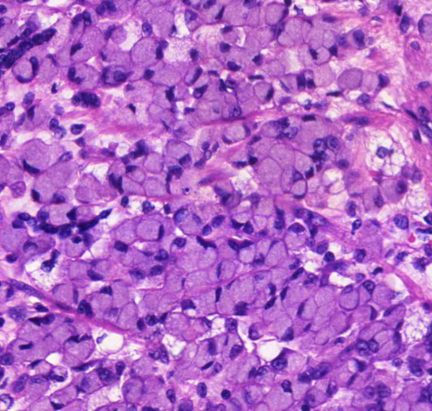 Adenocarcinoma ventriculi (diffuse type) pecsétgyurur2