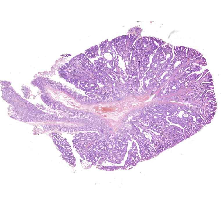 Adenoma tubulare coli