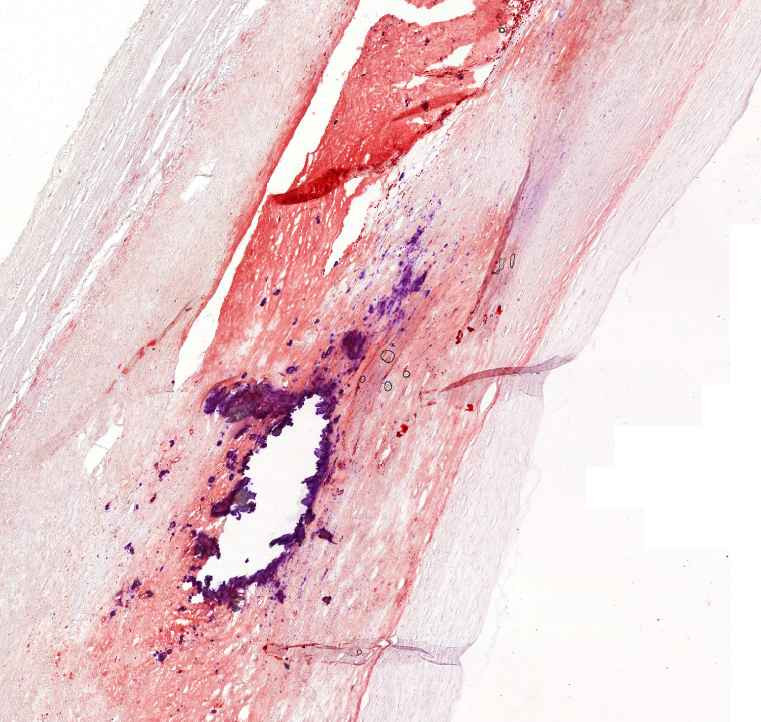 Atheromatosis arteriae (oil-red-o)