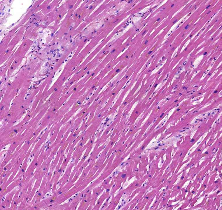 Atrophia brunea cordis-lipofuscin (and pericarditis)1