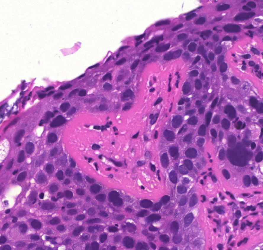 bronchus-metaplasia-dysplasia-carcinoma LOVE