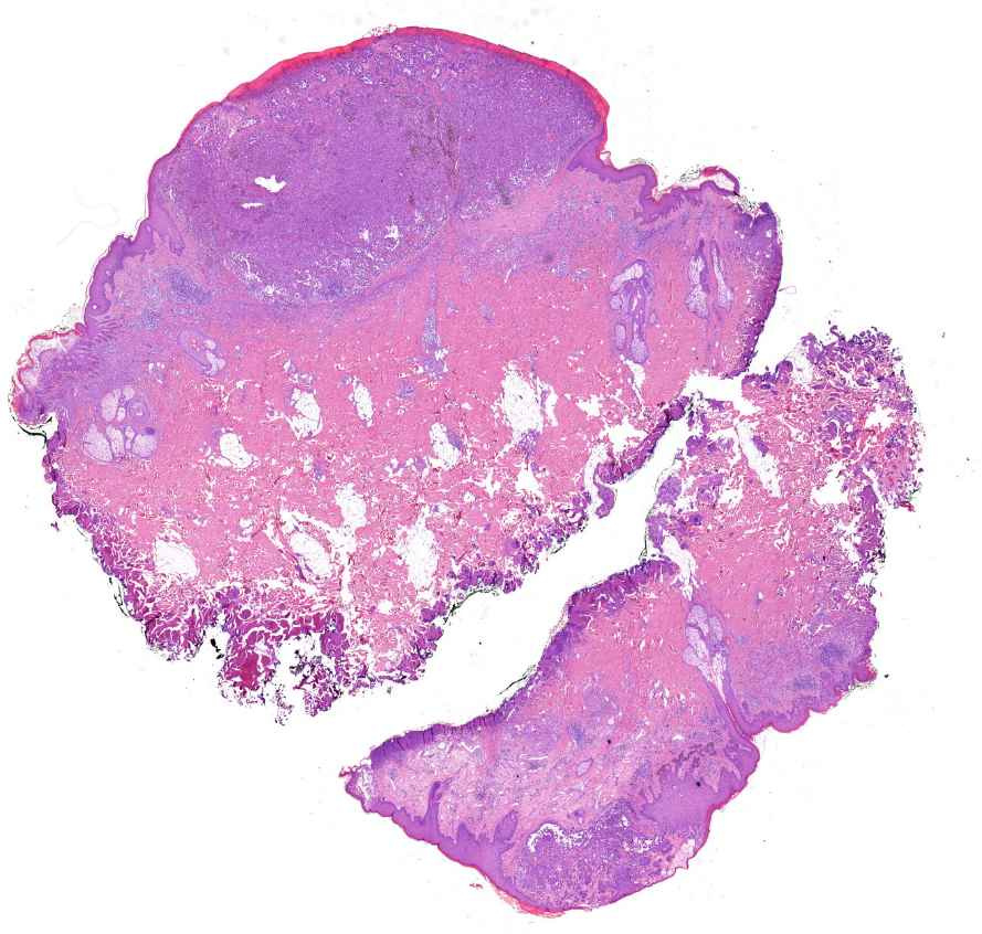 Melanoma malignum cutis