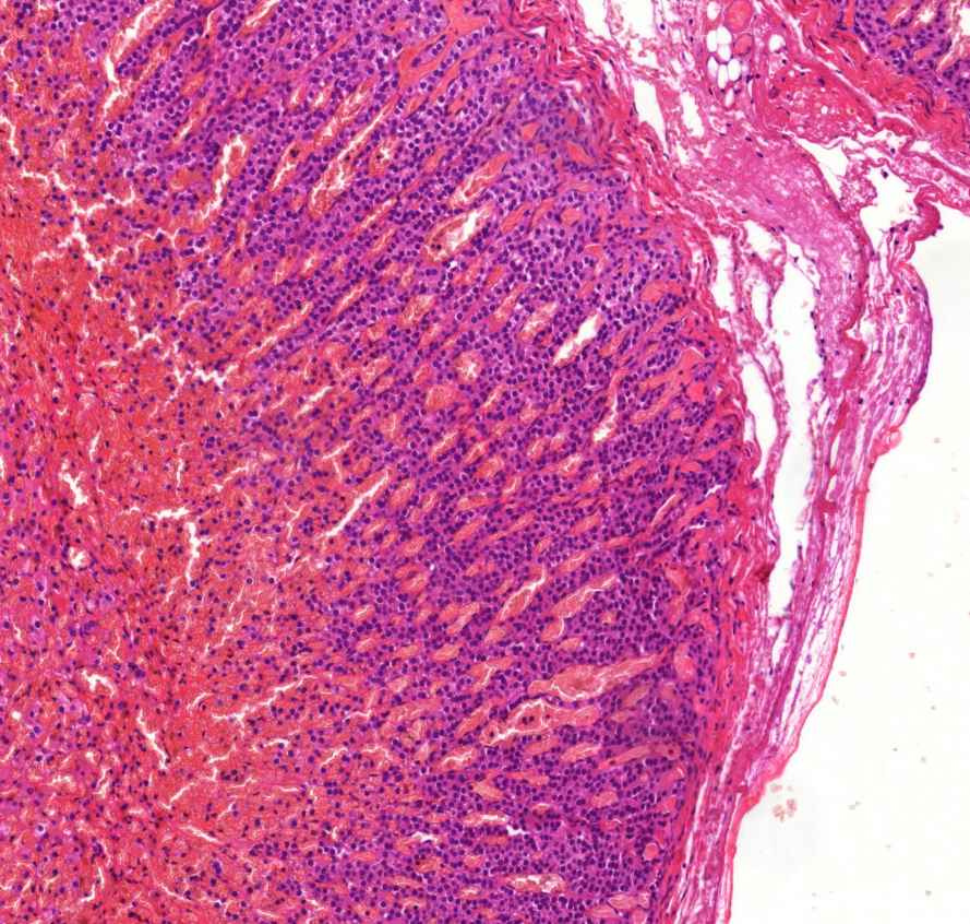 neuroblastoma1