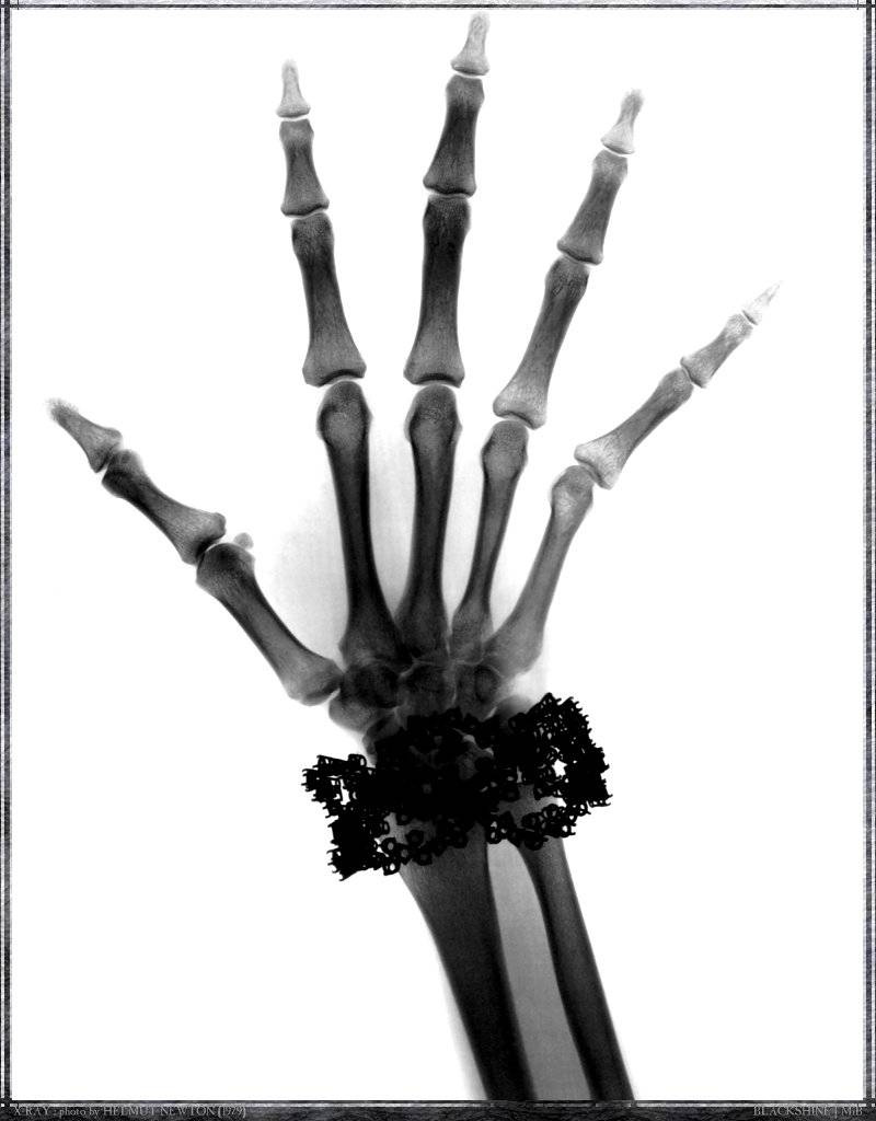 Helmut Newton - X-Ray Hand, 1979