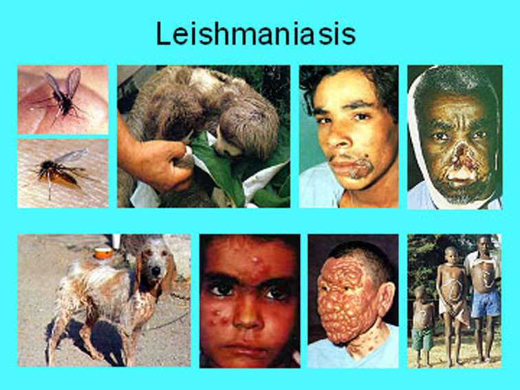 leismaniasis